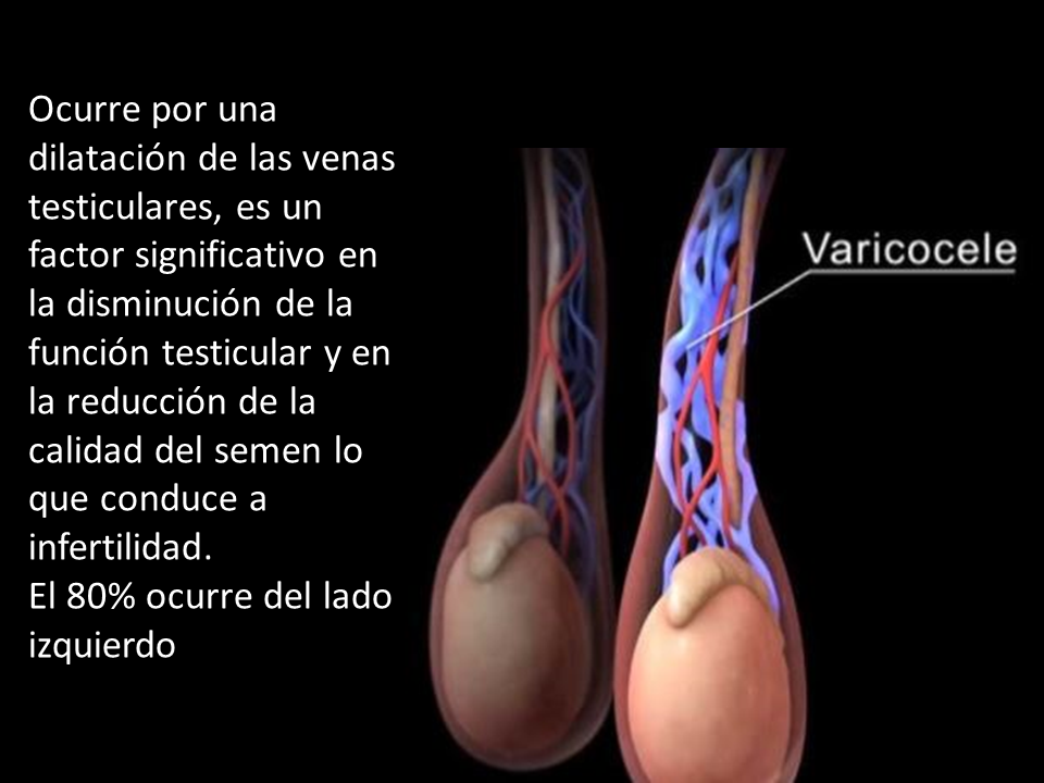 blog varicocele