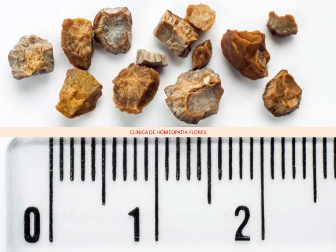 Las piedras de riñon