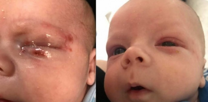 El herpes labial no es dañino para los adultos, pero puede resultar fatal para los bebés