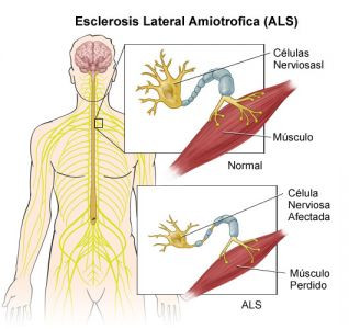 Que es la Esclerosis Lateral amiotrofica?