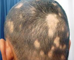 b2ap3_thumbnail_alopecia-areata.jpg